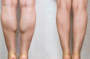Calf calves slimming london 