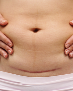 prp for c section scar treatment near me mayfair london