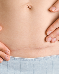 prp for c section scar treatment near me mayfair london