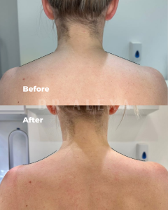 trap botox tox near me mayfair london