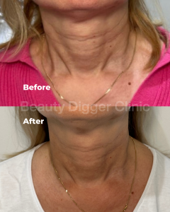 best sculptra treatment in london